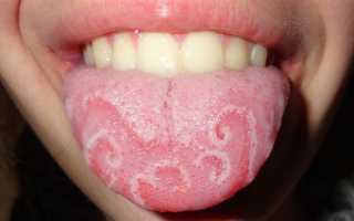 Лечение молочницы во рту у взрослых: от чего появляется и как лечить