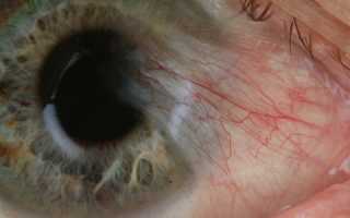 Все об эпиретинальной мембране глаза: что это такое и как ее лечить?