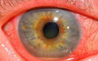 Что такое ретинит глаза? Симптомы и лечение заболевания