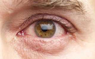 Лечение заболевания синдром сухого глаза: народные средства или препараты?