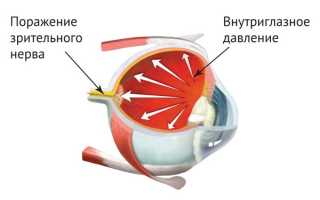 Симптомы глазного давления: какие причины приводят к повышенному и какие признаки об этом свидетельствуют?