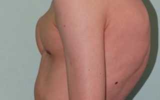 Кифоз грудного отдела позвоночника
