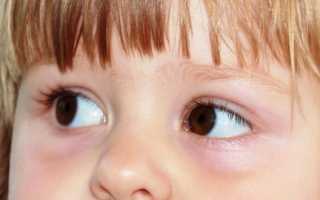 В чем проявляется аллергический конъюнктивит у детей? Эффективное лечение заболевания