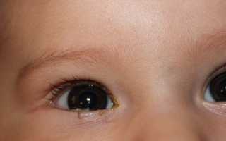 Почему закисают глазки у ребенка? Что делать и как помочь новорожденному?