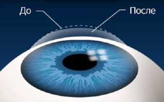 Как делают и сколько длится лазерная коррекция зрения?
