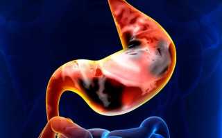 Что такое рак желудка, особенности протекания заболевания, лечение