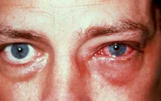 Эписклерит глаза: симптомы, виды болезни, ее диагностика и методы лечения