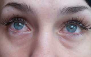 Что делать при химическом ожоге глаза после наращивания ресниц? Первая помощь