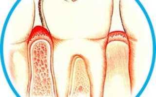 Полоскания как профилактика стоматологических заболеваний
