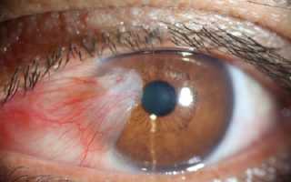 Почему образуется пленка на глазах у человека: прогнозы, профилактика и лечение