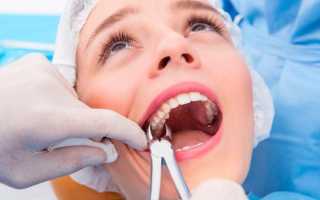 Местные осложнения после удаления зуба