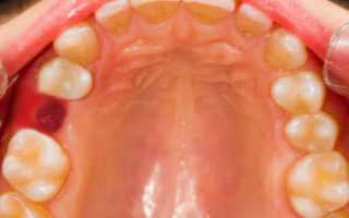 Альвеолит после удаления зуба – серьезное негативное последствие