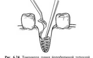 Местные осложнения, возникающие после операции удаления зуба