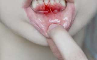 Кровь изо рта: вероятные причины и что при этом делать