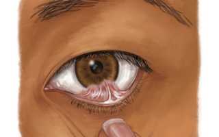 Что такое симблефарон глаза и чем он опасен?