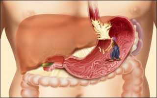 Как лечить желудочно-кишечный тракт: разновидности болезней и особенности терапии