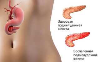 Признаки панкреатита у детей – дифференциация от прочих патологий ЖКТ
