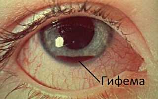 Фото гифемы глаза — как выглядит заболевание и в чем его опасность? Проведение лечения