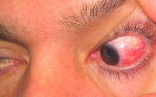 Склерит глаза: что это за заболевание и в чем его опасность? Важен системный подход к лечению