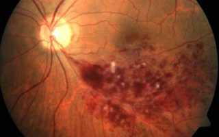 Диагноз — ПХРД глаза: возможны разрывы сетчатки!