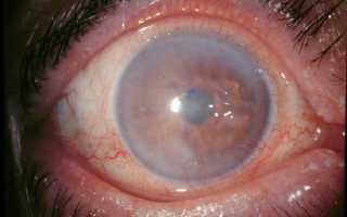 Что такое дистрофия роговицы глаза? Поддается ли заболевание лечению?