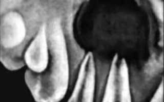 Особенности радикулярных кист нижней челюсти