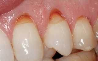 Зубной камень: причины возникновения и последствия