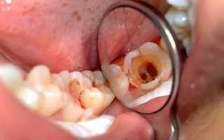 Сложное удаление зуба: особенности, показания, противопоказания, последствия