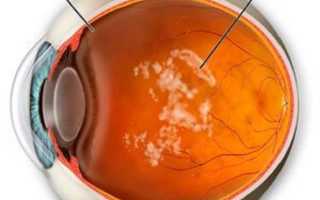 Как лечить помутнение стекловидного тела глаза?