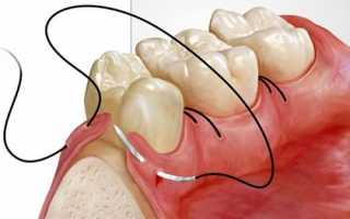 Восстановление расколовшегося депульпированного зуба