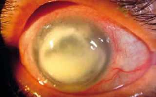 Гнойный эндофтальмит глаза — начните лечение вовремя, чтобы не потерять зрение