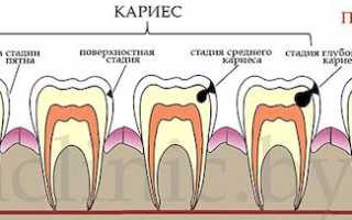 Депульпирование зуба перед протезированием: что это такое, зачем нужно и как проводиться