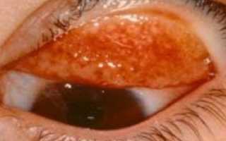 Трахома глаз — заболевание опасное, но поддающееся лечению!