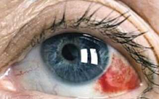 Как избежать кровоизлияния в глаз: гемофтальм и его последствия