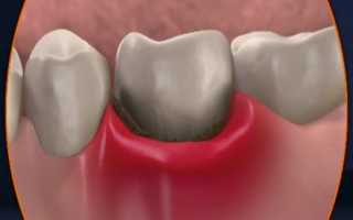 Болит десна после удаления зуба: норма или патология