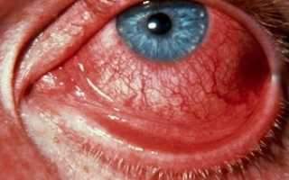 Как лечить хориоретинит глаза? Какую опасность несет заболевание?