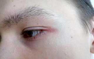 Почему болит уголок глаза ближе к виску или ближе к носу: причины и лечение симптома