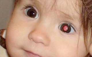 Каковы первые симптомы рака глаза у детей и взрослых? Как избежать осложнений?