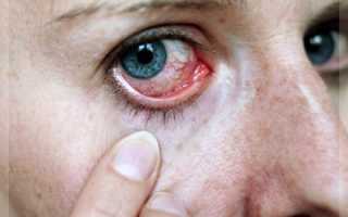 Почему появляются красные сосуды в глазах и как их убрать: причины и лечение симптома