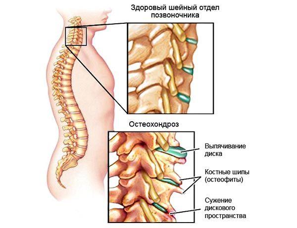 Выделяют несколько стадий развития шейного остеохондроза