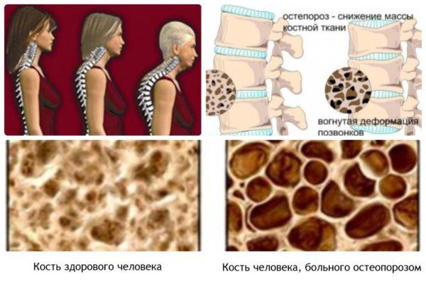 При наличии остеопороза переломы позвоночника в шейном отделе чаще всего имеют неблагоприятный прогноз