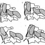 2-й позвонок (перелом палача, осевой перелом, спондилолистез)