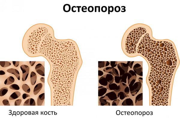Остеопороз чаще всего развивается у пожилых людей из-за возрастных изменений в организме, однако в некоторых случаях может коснуться и «молодежи»