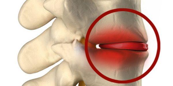 Инфицированный воспаленный диск вызывает цикличную боль в позвоночнике и прилегающих мягких тканях