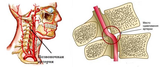 «Мексидол» при остеохондрозе шейного отдела: свойства, инструкция
