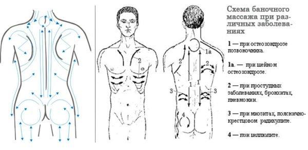 Схема кинетического баночного массажа