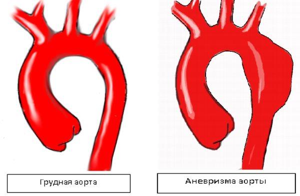 Схема аневризмы аорты
