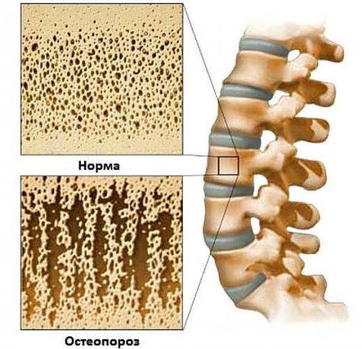 Причиной грыжи Шморля у людей пожилого возраста часто является снижение плотности костной ткани - остеопороз