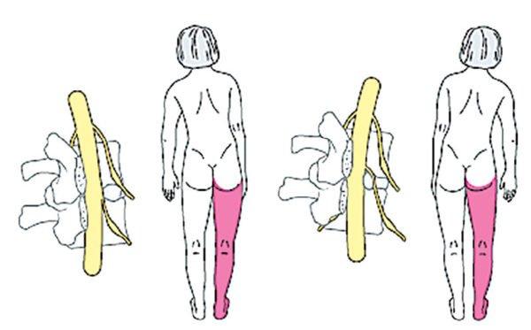 Пояснично-крестцовый сколиоз при грыже межпозвонкового диска вызывает боль в ноге