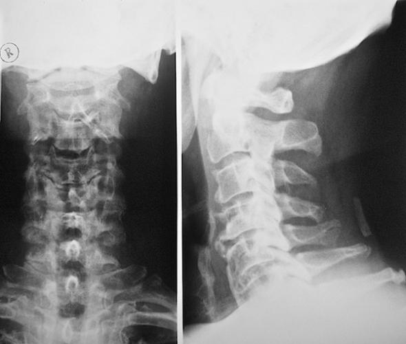 Чаще всего рентген назначают при остеохондрозе шеи